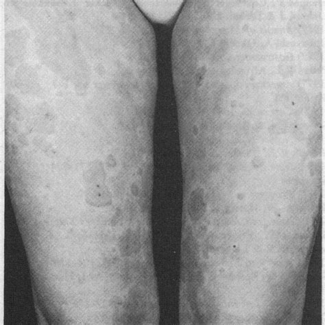 View Of Upper Legs To Show Figurate Erythema Mastoidectomy Had Been