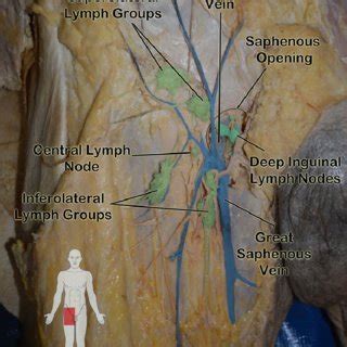 The inguinal hernia occurs when a section of the small intestine or fat pocket from the abdomen snakes down into the tubular canal that runs through the abdominal wall and pops out of a weakness in the peritoneum. The gallery for --> Groin Lymph Nodes Men