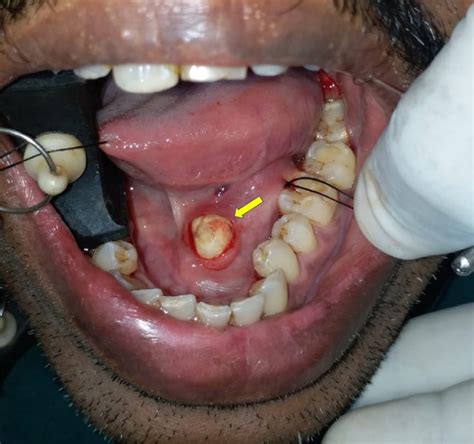 Sialolithiasis Of The Submandibular Gland Report Of Cases Abstract