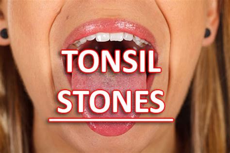 Tonsil Stone Prevention And Treatment In Carson City Nv Advanced
