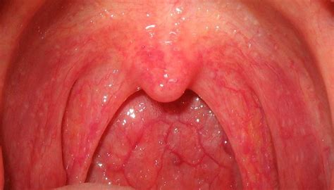 Lesion On Back Of Throat Throat Lesions Symptoms Mcascidos