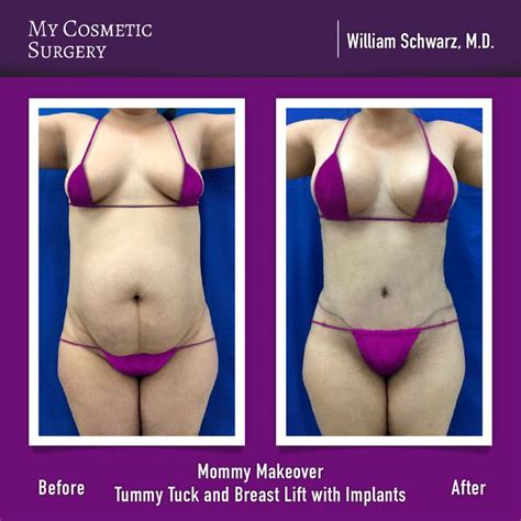 Before And After A Mommy Makeover By William Schwarz M D At My Cosmetic Surgery Miami