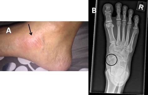 A Image Of Right Foot Showing Localized Erythema And Swelling Over