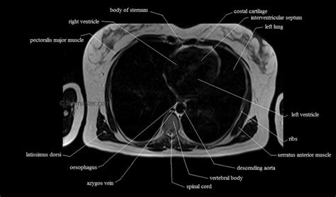 In a cross section of a bone we can see two types of bone tissue: chest anatomy | MRI chest (thorax)axial anatomy | free cross sectional anatomy