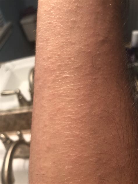 Itchy Rash On Forearm But None Of My Searches Seem To Match What Ive