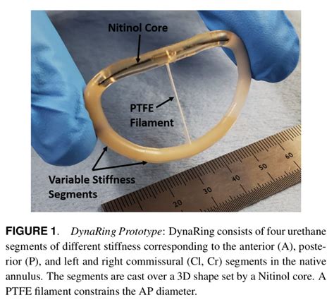 Biomimetic Annuloplasty Ring For Mitral Regurgitation
