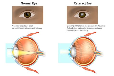 Eye Cataract Without