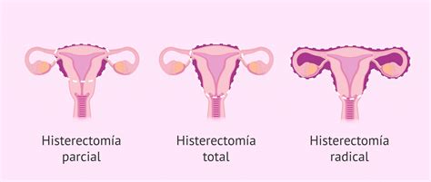 Qué es la histerectomía
