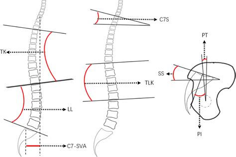 Method To Measure Spine Sagittal Alignment Pt Pelvic Tilt Ss Sacral