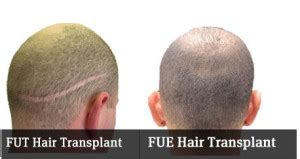 Benefits Of Fue Hair Transplant