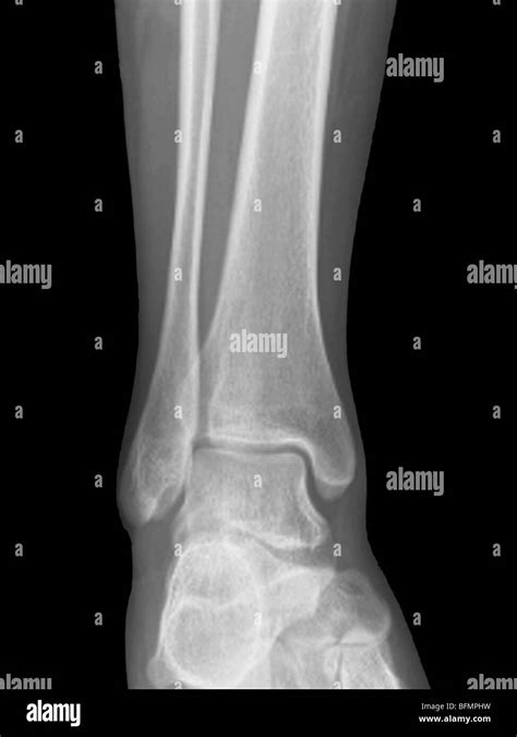 X Ray Foot Normal