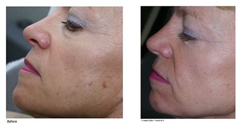 Ipl Laser For Age Spots And Sun Damage Cosmeticsenvogue