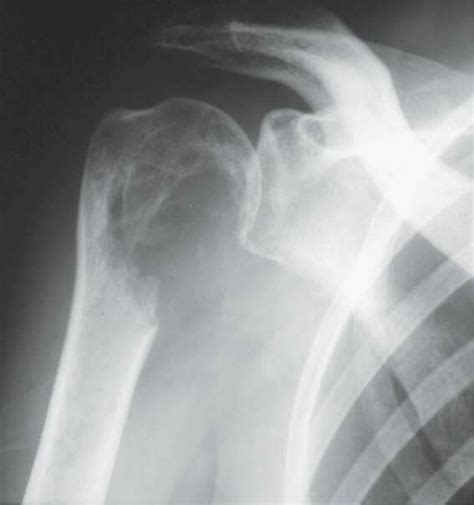 Radiography Of Adult Right Shoulder Joint A Destructive Lytic