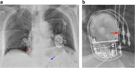 Perioperative Interrogation Of Biotronik Cardiovascular Implantable