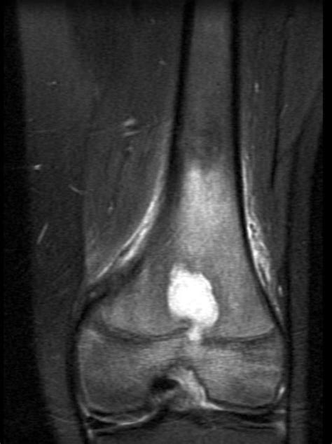 Brodie abscess | Image | Radiopaedia.org