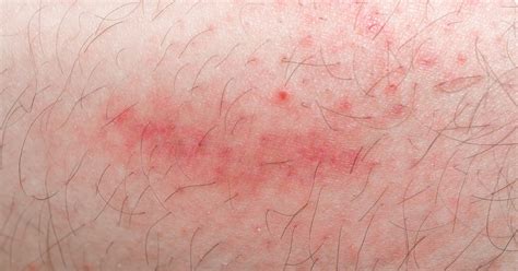Allergic Reaction Skin Rash Itchy