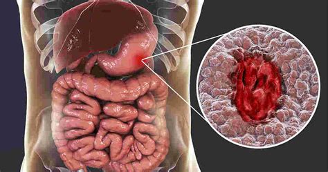 Stomach Ulcers Causes Types Symptoms Treatment