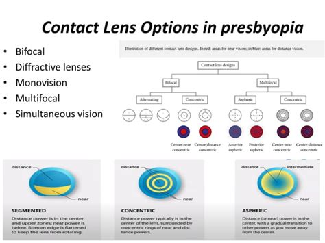Presbyopic Contact Lens Description
