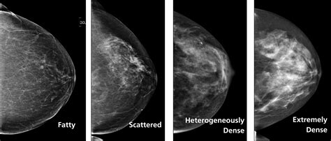 Advice For Breast Cancer Awareness Month Know Your Breast Density
