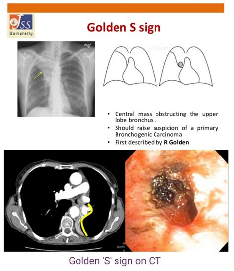 Golden S Sign On Ct Bronchogenic Carcinoma Medical Knowledge