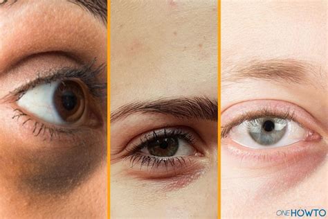 6 Types Of Dark Circles Under The Eyes And How To Treat Them