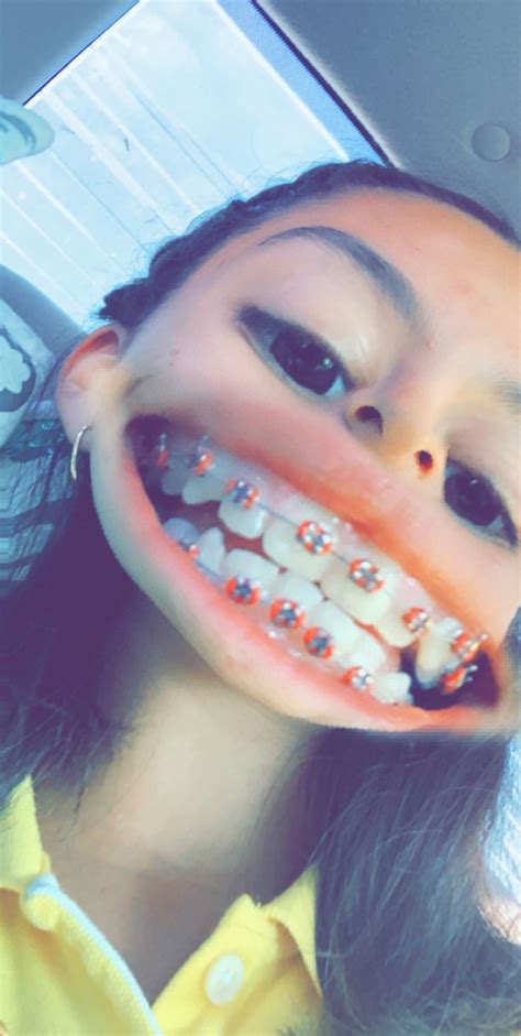 Pin On Braces Color