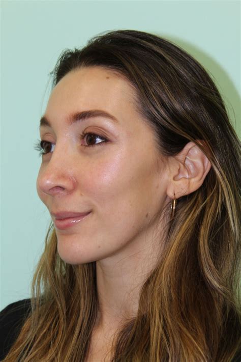 Rhinoplasty Davis Facial Plastic Surgery