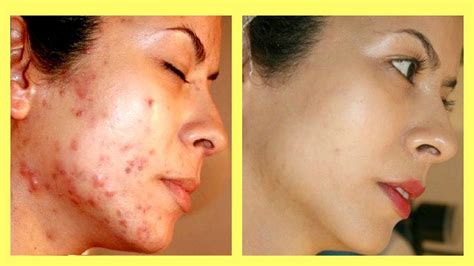 Top 4 Ways How To Get Rid Of Acne Scars Overnight Naturally At Home