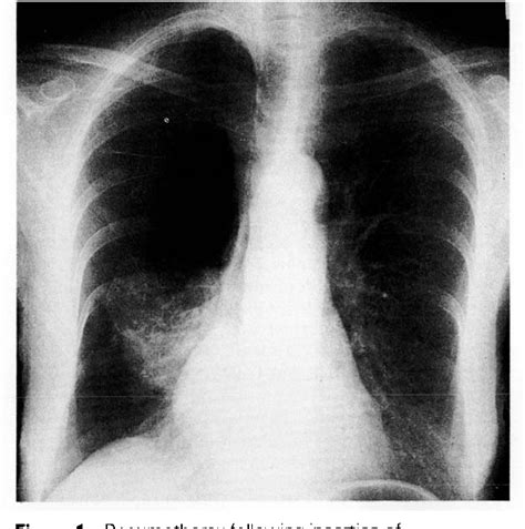 Figure From Pneumothorax Following Insertion Of Subcutaneous Needle