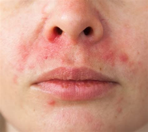 What Is Perioral Dermatitis Find Out From The Dermatologist Dr