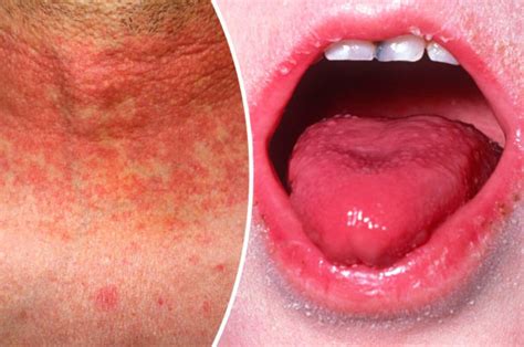 Scarlet Fever Symptoms Outbreaks Reach 50 Year High Here Are The