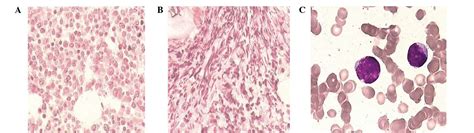 Blastic Plasmacytoid Dendritic Cell Neoplasm With Leukemic