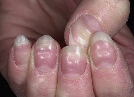 Health Warnings Your Fingernails May Be Sending