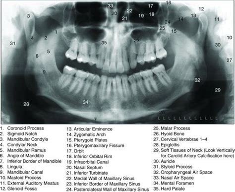 Dentaltown Anatomical Landmarks On A Panoramic Radiograph Oral