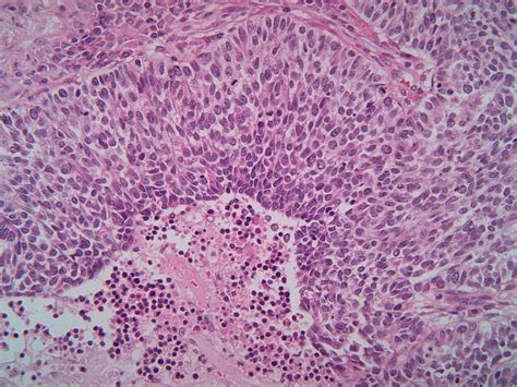 Large Cell Carcinoma Of The Lung