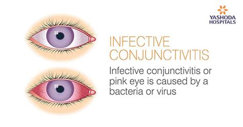 Infective Conjunctivitis Causes Symptoms And Prevention