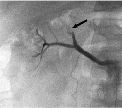 Postembolization Control Angiography Revealed Coil Arrow Occluding