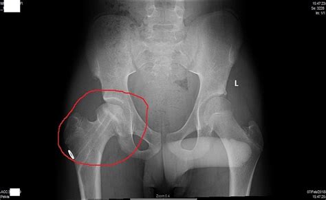Hip Replacement Chinese Solution