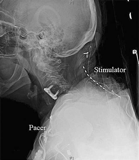 Successful Treatment Of Occipital Neuralgia With Implantable Peripheral
