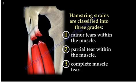 Hamstring Injury Symptoms Recovery Treatment