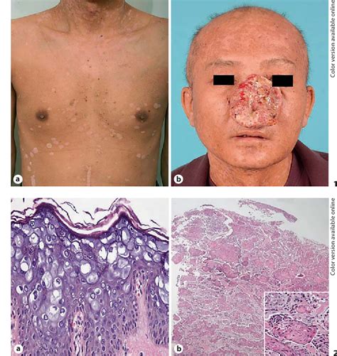 Figure 1 From Development Of Aggressive Squamous Cell Carcinoma In