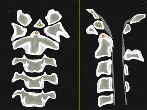 Figure Os Odontoideum Anterior Posterior Left Sided Image