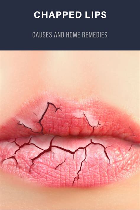 Chapped Lips Causes And Home Remedies Treating Chapped Lips Chapped