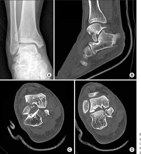 Figure 1 From Concomitant Fracture Of The Lateral Process Of The Talus