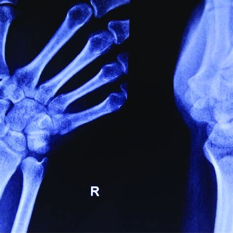 Radiograph Of Wrist Showing Dense Sclerotic Focus In Scaphoid Region