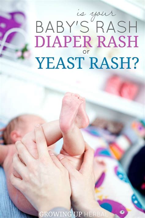 Is Your Babys Rash Diaper Rash Or Yeast Rash Guh Baby Rash Baby