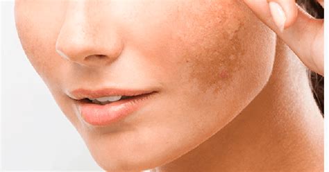 What Is Melasma And Whats The Best Way To Treat It