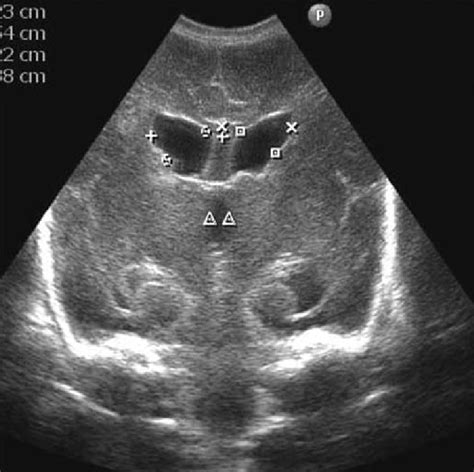 Cranial Ultrasound Scan Showing Moderate Dilatation Of The Lateral