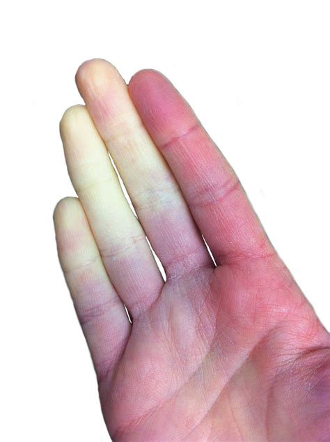 Lupus Toenails - Nail Ftempo