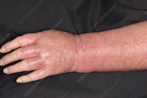 Cellulitis Stock Image C0498176 Science Photo Library